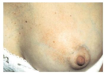 An inflamed, painfully tender breast combined with flu-like symptoms may indicate that a nursing mother has mastitis. Frequent feeding or pumping from the affected breast can help, as can rest and drinking lots of fluids. [Photograph by Dr. P. Marazzi. Photo Researchers, Inc. Reproduced by permission.]